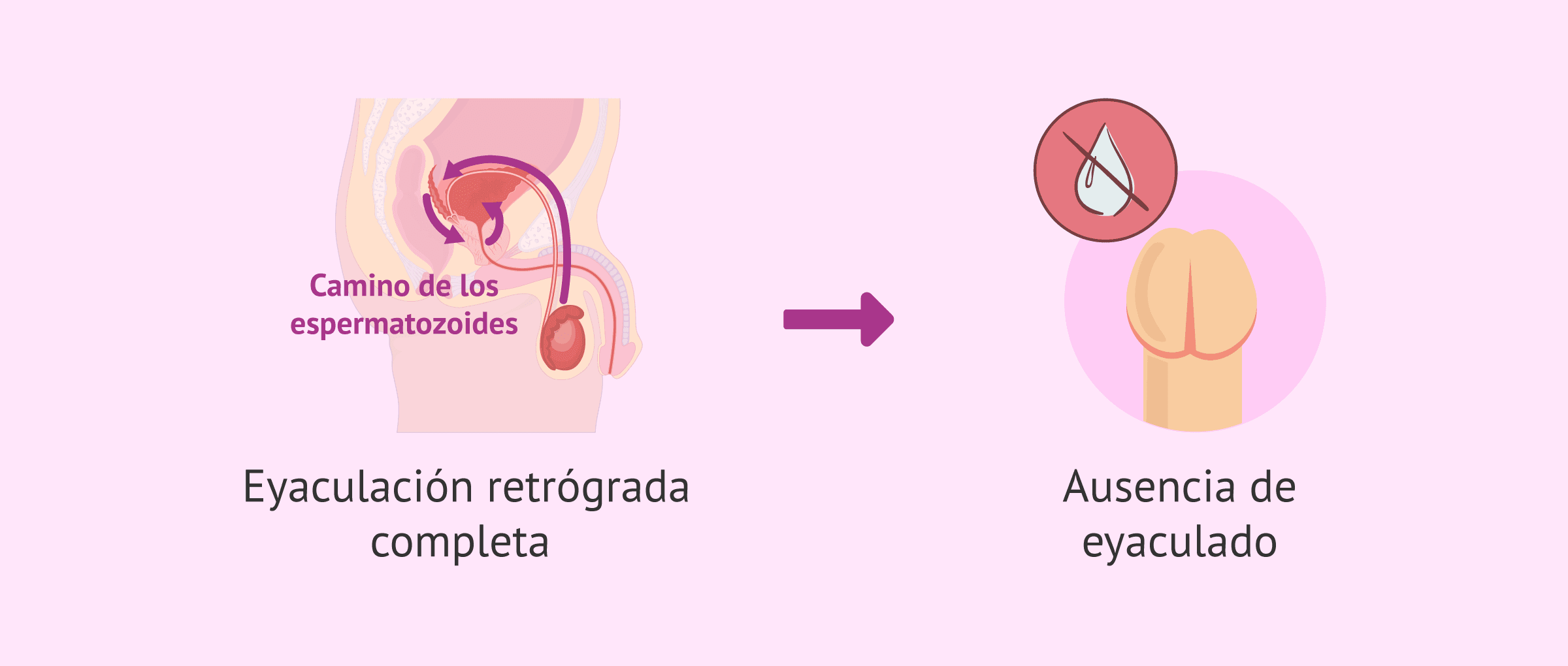 Imagen: Consecuencias de la eyaculación retrógrada completa