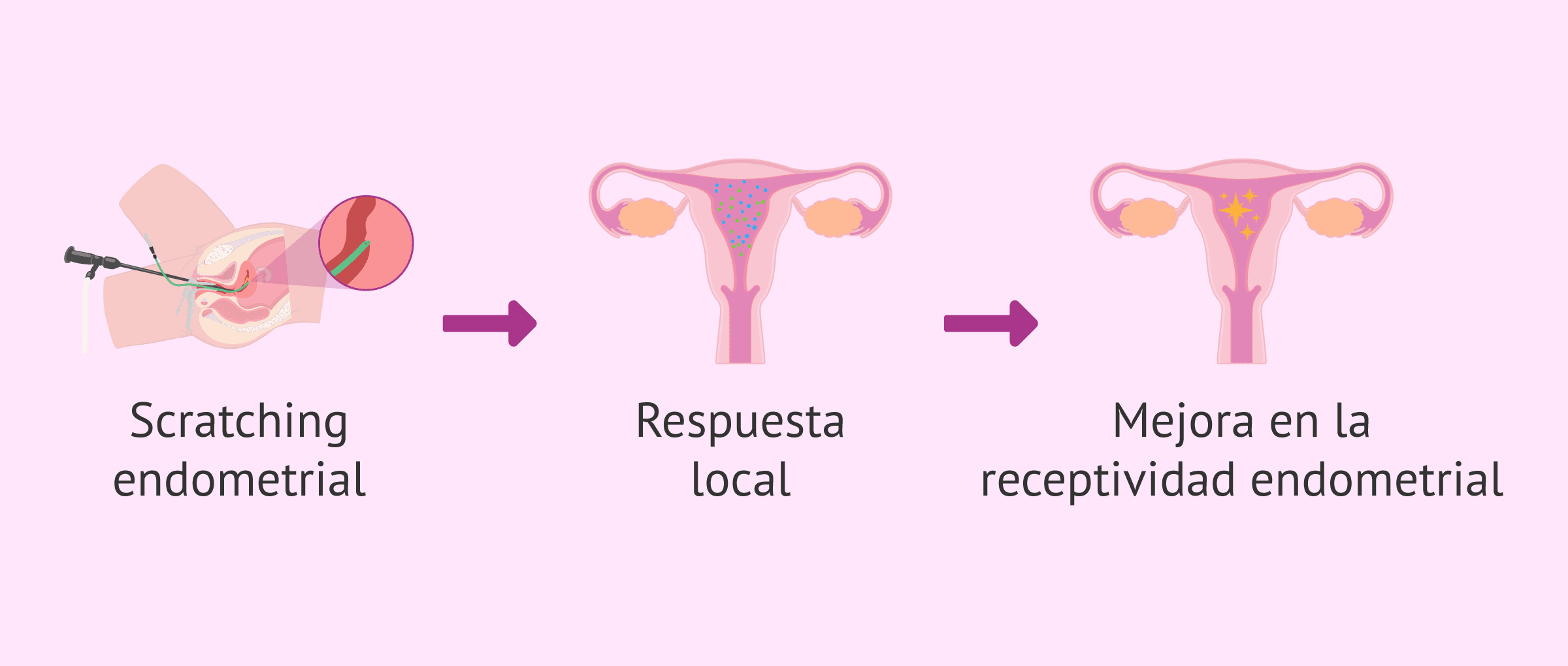 El scratching endometrial y el impacto en tu futura gestación
